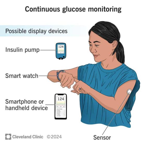 Glucose Monitoring - Cleveland Clinic
